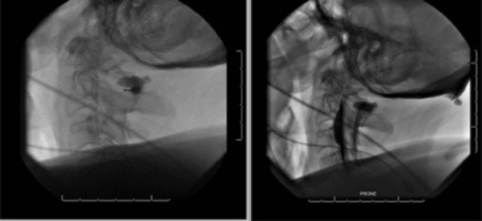Immediate communication of injected contrast into the ventral pseudomeningocele from C2 to C4