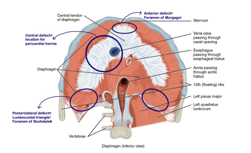 Pericardial hernia occurs when defect in diaphragm allows abdominal contents to enter pericardial sac. (This work is a derivative of "Creative Commons 1113 The Diaphragm" by OpenStax, used under CC BY 4.0)