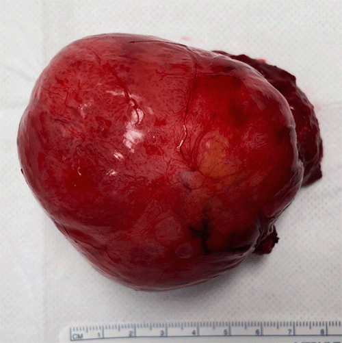 A) Tumor post-resection