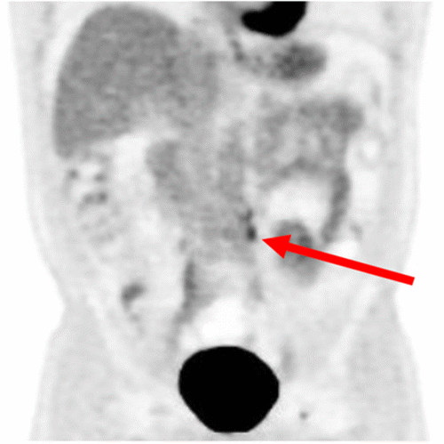 Composite image demonstrating the recurrent para-aortic metastasis. (A) Coronal contrast-enhanced CT scan revealing a soft tissue mass (arrow) in the left para-aortic region, consistent with nodal recurrence. (B) Corresponding PET scan image showing intense fluorodeoxyglucose (FDG) uptake (arrowhead) within the left para-aortic lesion, indicative of metabolically active malignant disease