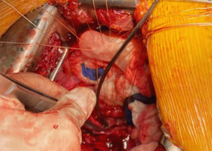 The patch was parachuted down onto the defect visible at the bottom of the image with the suction tip in the center of the defect.