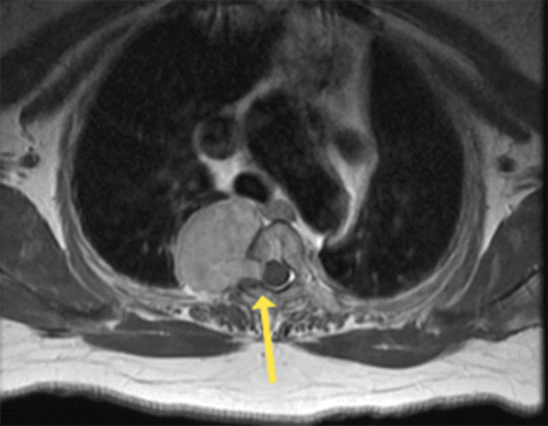 A. Thoracic spine at the level of T2, demonstrating right-sided mass extending out of the T2 neural foramen (arrow) and into the thoracic cavity. 