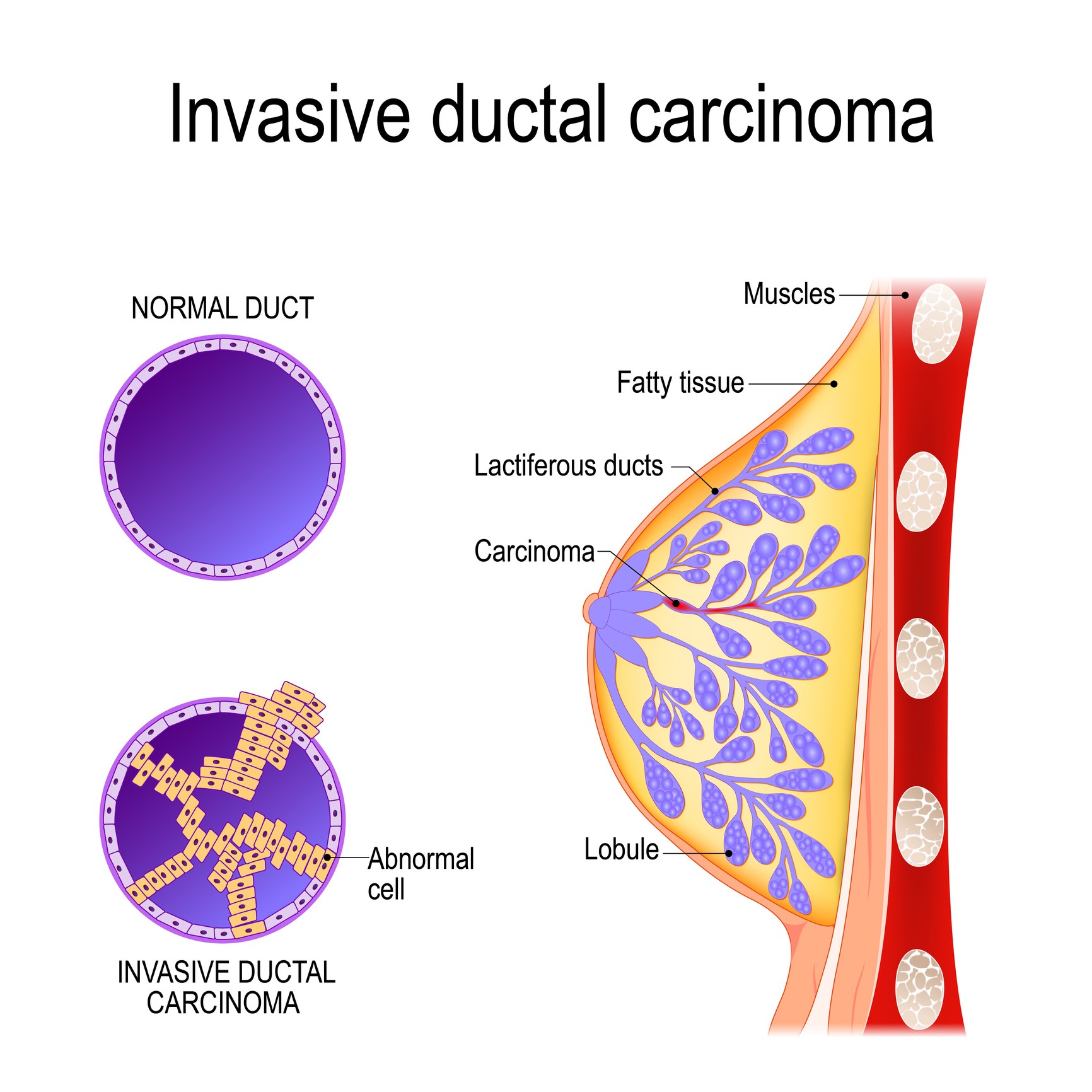 invasive ductal carcinoma case study