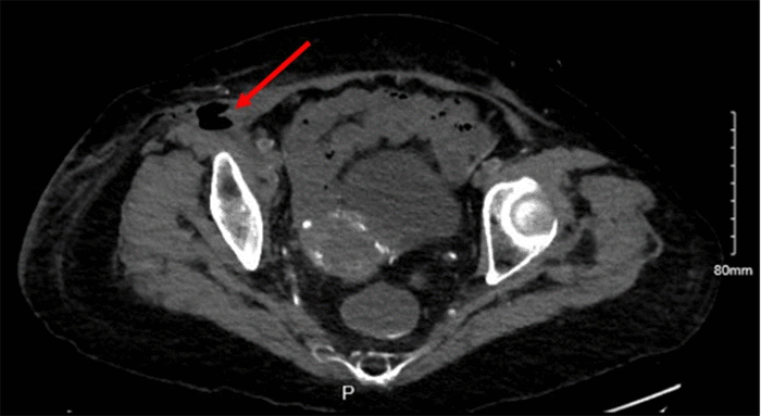 CT Abdomen and Pelvis showing fat stranding, gas, and fluid in the right pelvic wall.