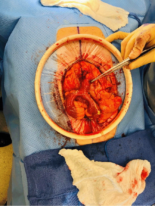 A) Intraoperative view of perforated Meckel’s diverticulum with forceps pointing out perforated tip.