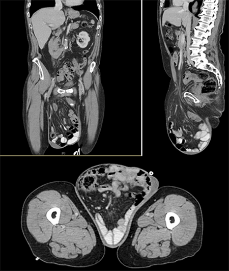 Figure 2. Contrast enhanced CT of the abdomen and pelvis in coronal, sagittal, and axial views