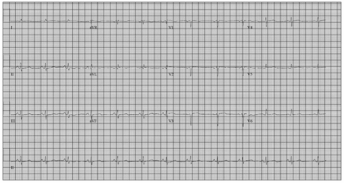 A 12-lead ECG obtained on postoperative day 0 during the acute cardiorespiratory event. The tracing demonstrates sinus tachycardia (approximate heart rate [107-111 beats per minute]) without ST-segment elevations, significant ST-segment depressions, pathological Q waves, or new T-wave inversions that would typically indicate acute myocardial ischemia or infarction