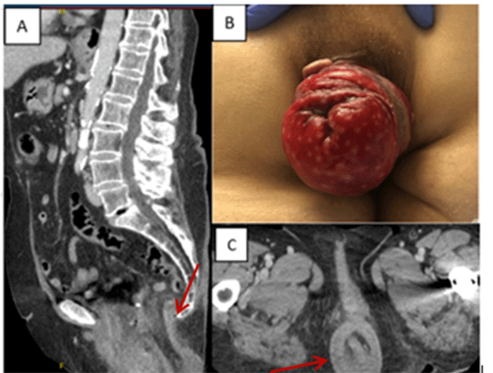 A) Sagittal CT demonstrating coloanal intussusception; B) clinical presentation of coloanal intussusception in the emergency department; C) axial CT view of the intussusception