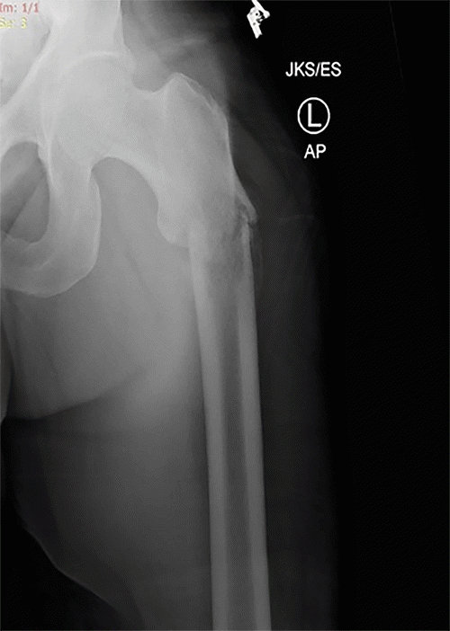 (A) Anteroposterior and (B) Lateral radiographs of the left femur obtained after closed reduction of a spontaneous pathological shaft fracture. The images demonstrate alignment of the fracture fragments with a Buck's traction device in place