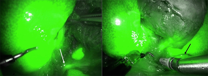 Cystic duct and common bile duct junction (white arrow); Sulcus of Rouvière (black arrow)