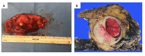 Figure 2: Gross macroscopic appearance of resected adrenal gland. A: Gross macroscopic appearance of resected left adrenal mass specimen showing a soft to firm, yellow-tan lobulated fatty specimen measuring 8.2 x 5 x 3.5 cm and weighing 49.5 grams; B: Appearance upon serial sectioning of 3.0 x 2.5 x 1.5 cm hemorrhagic area surrounded by a 5.3 x 1.0 x 1.0 cm thin rim of distinguishable yellow-tan adrenal gland.