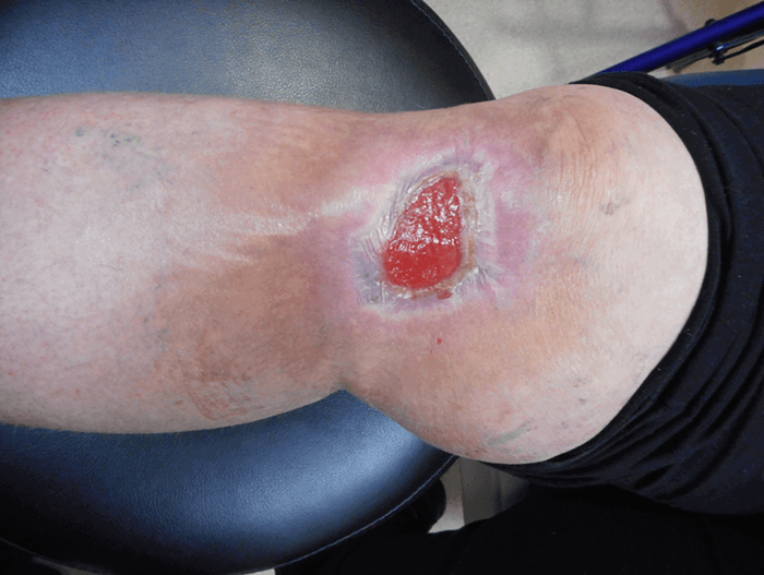 Figure 6. Wound at 4-months post-operation