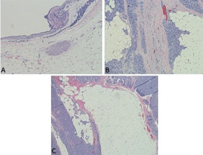 (A) Cystically dilated duct with benign epithelium, stroma, and smooth muscle within mature adipose tissue (10x magnification). (B) Benign pancreatic acinar tissue and fibrous stroma interspersed with mature adipose tissue (10x magnification). (C) Mature adipose tissue infiltrating pancreatic tissue (4x magnification)