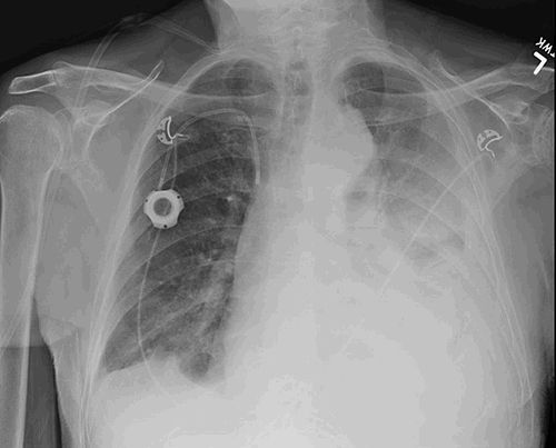 Figure 1. Left sided pleural effusion visible on chest radiograph