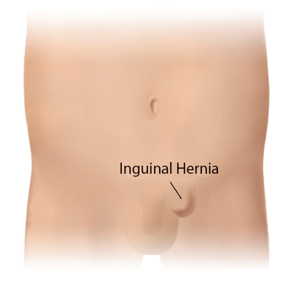 Pediatric Inguinal and Femoral Groin Hernia Repair