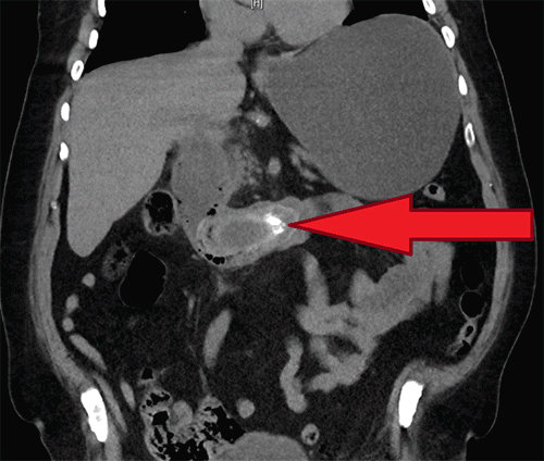 Non-contrast coronal CT of the abdomen. The image shows a large, ovoid intraluminal filling defect (arrowhead), consistent with the impacted 8.3 cm gallstone, within the second and third portions of the duodenum, associated with surrounding pneumatosis intestinalis