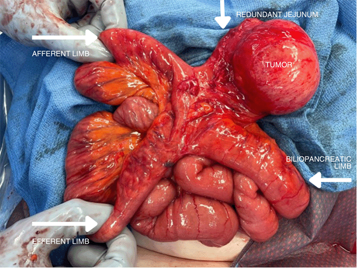 Mass originating from the redundant jejunum and invading the mesojejunum, measuring 8.5 x 7.0 x 7.0 cm.