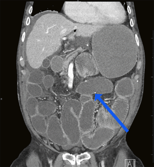 Note distended stomach and small bowel loops and a patent ileocolic anastomosis (blue arrow); no evidence of leakage