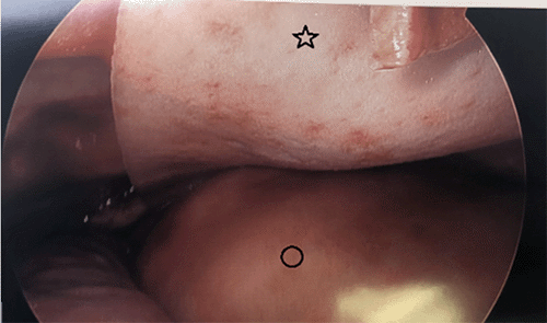 A) Intrathoracic image of underlay mesh (star marks mesh, circle marks diaphragm)