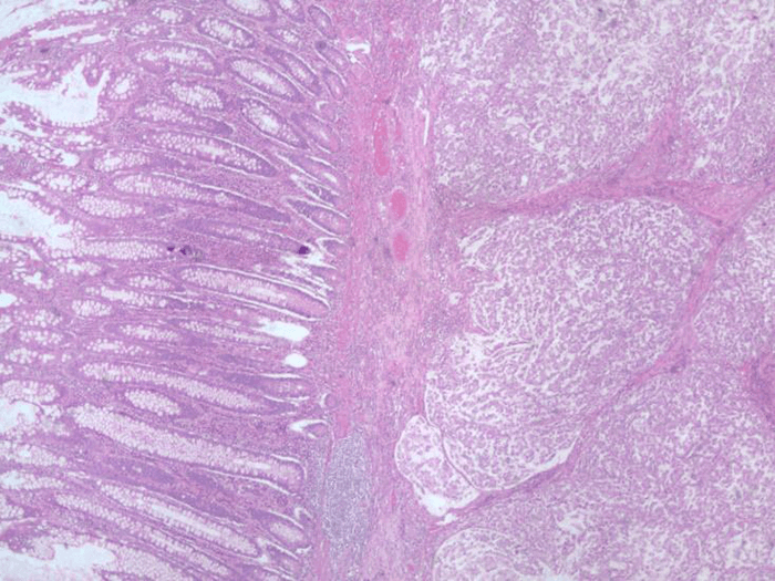 Figure 1. Hematoxylin and eosin stain of primary goblet cell carcinoid tumor in ascending colon.