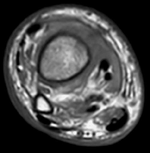 A) Axial T1 MRI 