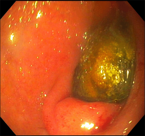 Gallstone impacted within the second portion of the duodenum, as identified via upper endoscopy