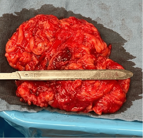 Significant volume of retroperitoneal fat excised from the hernia sac