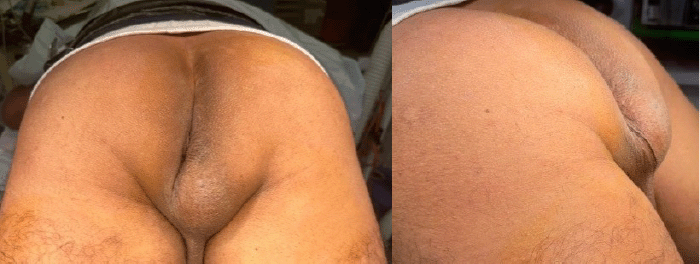 Clinical photographs of the perianal region prior to surgery. (A) Posterior view illustrating the location of the mass in the right ischiorectal fossa (anterolateral to the anal verge, medial to the ischial tuberosity). Note the subtle overlying skin changes attributed to chronic friction. (B) Lateral view demonstrating the prominent bulge created by the underlying mass, causing deviation of the median raphe to the left