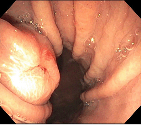 Upper GI endoscopy demonstrating exophytic nature of the lesion and location on lesser curvature of stomach.
