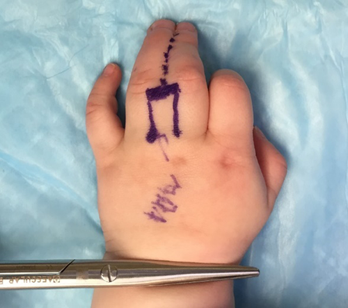 Figure 1. Preoperative picture with surgical markings dorsum of the hand.