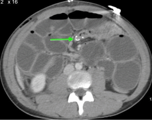 (C) Axial view  of the ileocolic anastomosis (green arrow)