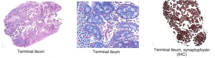 Figure 2. Histology from preoperative endoscopic biopsy of ileal mass