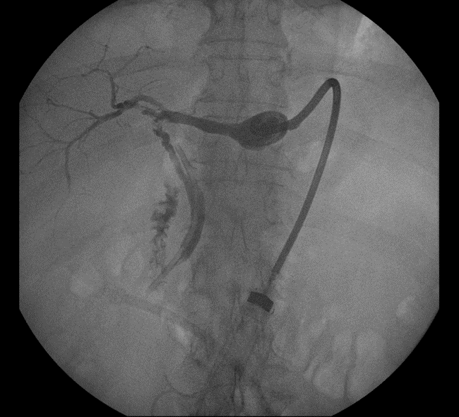 Figure 3. Tube check cholangiogram through percutaneous pigtail drain into biloma in the gallbladder fossa demonstrates new patency of the cystic duct (thick arrow) and back-filling of the CBD out of the biloma (thin arrow). 
