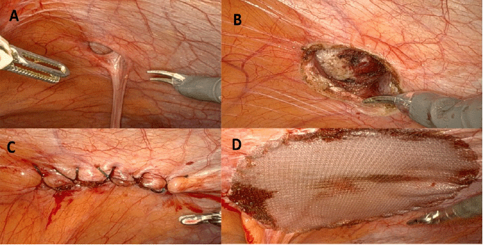 (A) Preoperative incisional hernia through a 2 cm defect at the prior PEG site. (B) Abdominal wall defect after robotic dissection and hernia reduction. (C) Primary closure of the fascial defect. (D) Defect reinforced with a 4.5 cm Bard Echo circular mesh