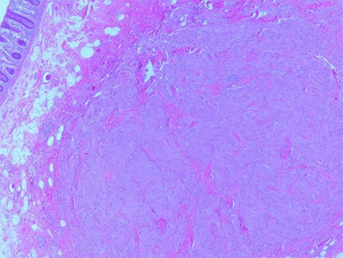 A. 20x magnification: 5 mm residual nodule in submucosa