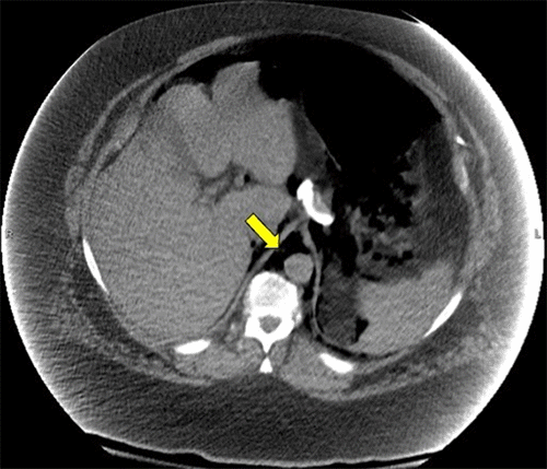 B) Abdomen CT depicting air in retroperitoneum—yellow arrows show air