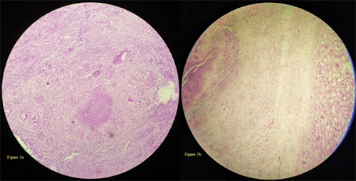 A) Multiple well-formed granulomas with epithelioid cells, histiocytes, langhan type multinucleated giant cells, lymphocytes and areas of caseous necrosis and B) parts of normal testicular parenchyma on left along with necrotizing granuloma on right side.