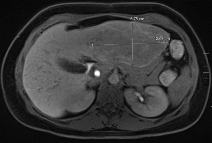 (A) Axial coronal gadoxetate-enhanced MRI liver image demonstrating a 10.6 × 12.1 × 6.8 cm left lobe segment II-IV lesion exhibiting heterogeneous enhancement that persists into the hepatobiliary phase, along with a T2-hypointense central scar. Additionally, two areas consistent with focal nodular hyperplasia are identified in segments IVb and VI, along with three small (~1 cm) lesions likely consistent with hepatic adenomas in segments VI and VII