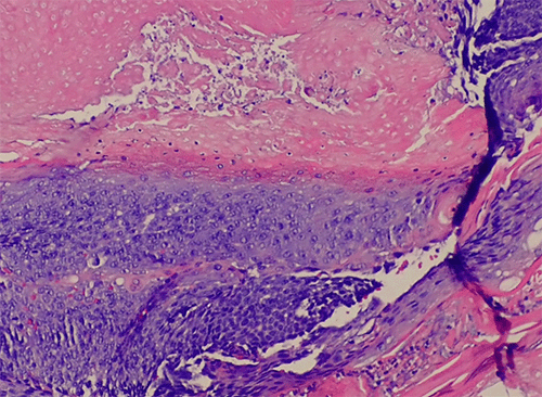 (B) Higher magnification shows an island of epithelial cells with basophilic cytoplasm transitioning into shadow/ghost cells in the central region of the tumor