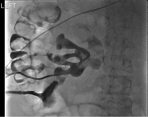 A) Immediate filling of fistula from left middle pole calyx into descending colon