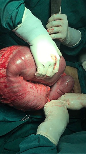The Big Hit of Vape That Led to a Pneumothorax | ACS The Big Hit of Vape That Led to a Pneumothorax | ACS