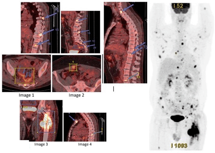 Fused PET-CT images of the left femur obtained following orthopedic fixation. The image demonstrates intense focal fluorodeoxyglucose (FDG) uptake (SUVmax 19.30, arrow) at the site of the pathological fracture and surgical repair, consistent with metabolically active metastatic adenocarcinoma. Note the associated expansile osteolytic destruction and adjacent soft tissue involvement