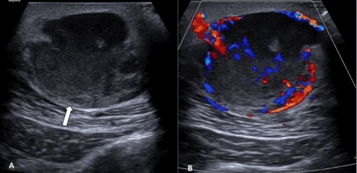(A) Grayscale ultrasound image demonstrates a round, heterogeneous, echogenic mass located within the subcutaneous fat, exerting mass effect on the underlying latissimus dorsi muscle (arrow). (B) Color Doppler imaging of the mass shows evidence of both peripheral and internal arterial and venous flow, indicative of significant vascularity and making a simple abscess or hematoma unlikely