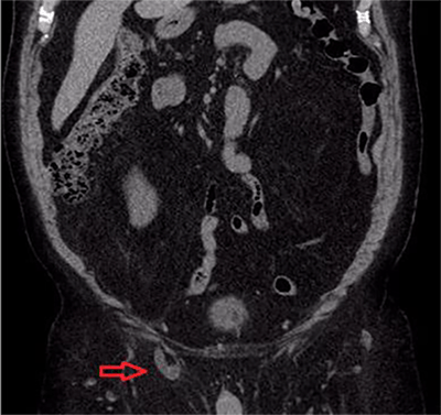 Figure 3. Coronal view of same study showing dilated incarcerated ureter in hernia sac.