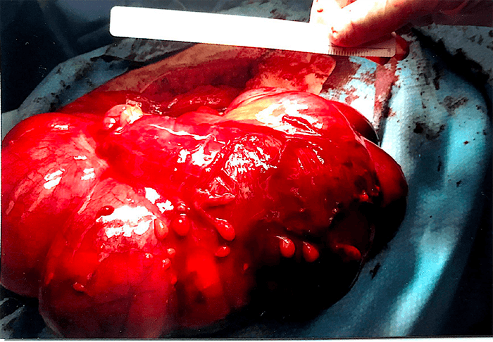 Figure 2. Anterior view of anomalous colon in situ after reflection of anterior abdominal wall. Greater omentum has been reflected upwards. Note the size of the cecum. Jejunum and ileum were occupying right part of the abdomen and transverse colon was found in a diagonal position. 