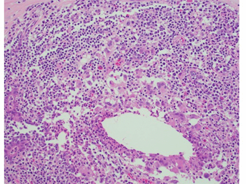 Right breast histopathology showing granulomatous inflammation with giant cells, histiocytes, and admixed lymphocytes; 20x magnification.