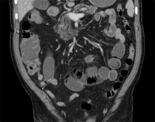 Transition point at arrow in the left lower quadrant. This finding would subsequently lead to laparoscopy.