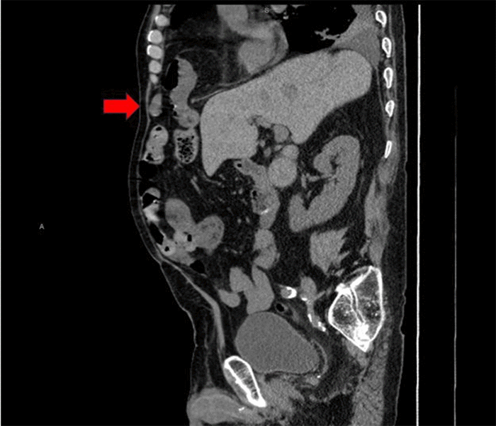 Sagittal reformatted view from a CT scan of the abdomen. This image clearly displays the anteriorly positioned diaphragmatic defect characteristic of a Morgagni hernia, with loops of small bowel and omentum (red arrow) seen protruding superiorly through the diaphragm