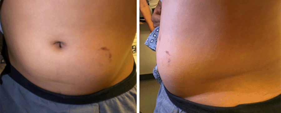 can i ride a bike with an inguinal hernia
