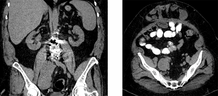 Figure 1. Large right retroperitoneal mass (a) and associated large anterior wall abdominal hernia (b)